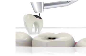 Trattamenti Studio Fratus: Conservativa