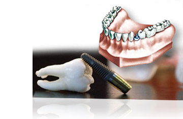 Trattamenti Studio Fratus: Implantologia